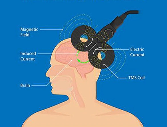 How TMS works